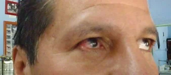 Trabajador presenta lesión ocular por proyección de partícula metálica en el ojo