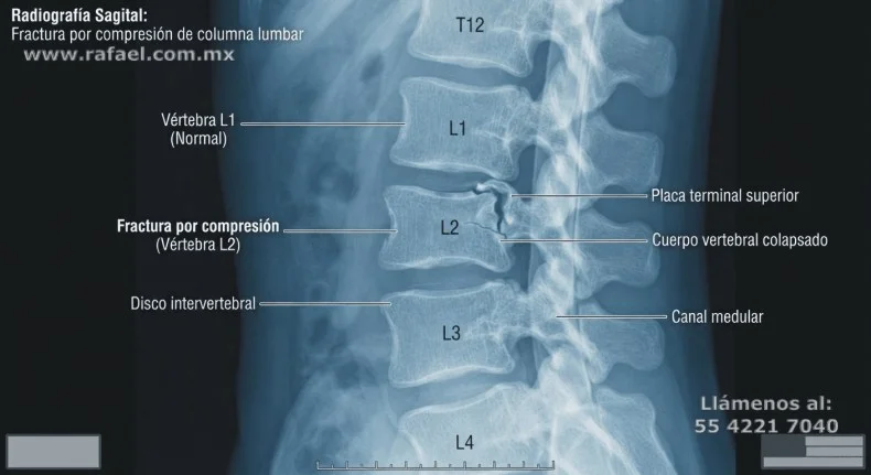 Informe del daño en columna vertebral de un trabajador, radiografía muestra compresión entre vértebras